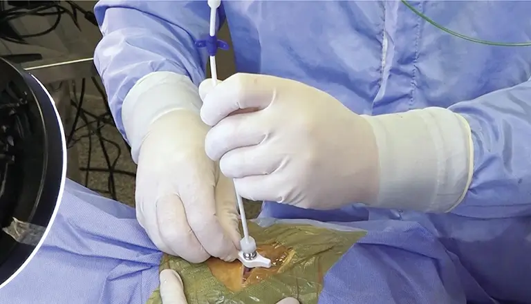 PIC VENTRICULAR